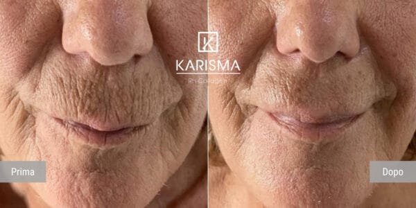 KARISMA Rh Collagen® - Image 5