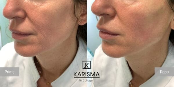 KARISMA Rh Collagen® - Image 6