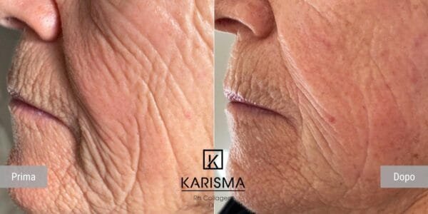 KARISMA Rh Collagen® - Image 7