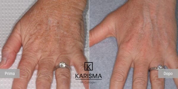 KARISMA Rh Collagen® - Image 8