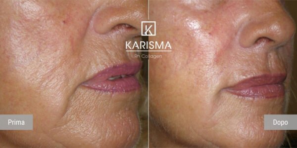 KARISMA Rh Collagen® - Image 4