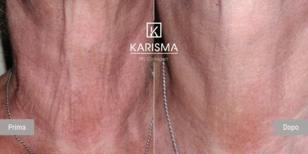 KARISMA Rh Collagen® - Image 9